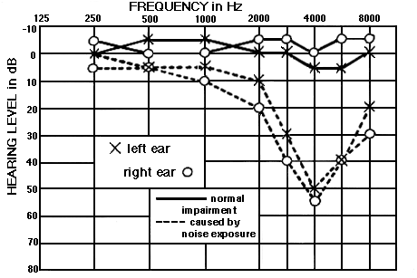 audiogram